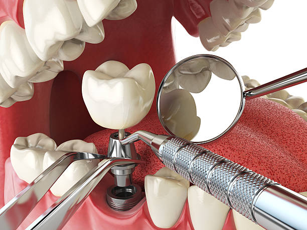 Best Emergency Treatment for Dental Infections or Abscesses in Cambridge, OH