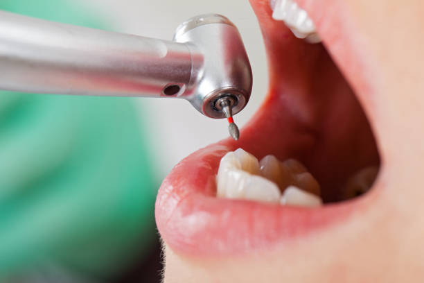 Best Emergency Dental Care for Broken or Chipped Teeth in Cambridge, OH